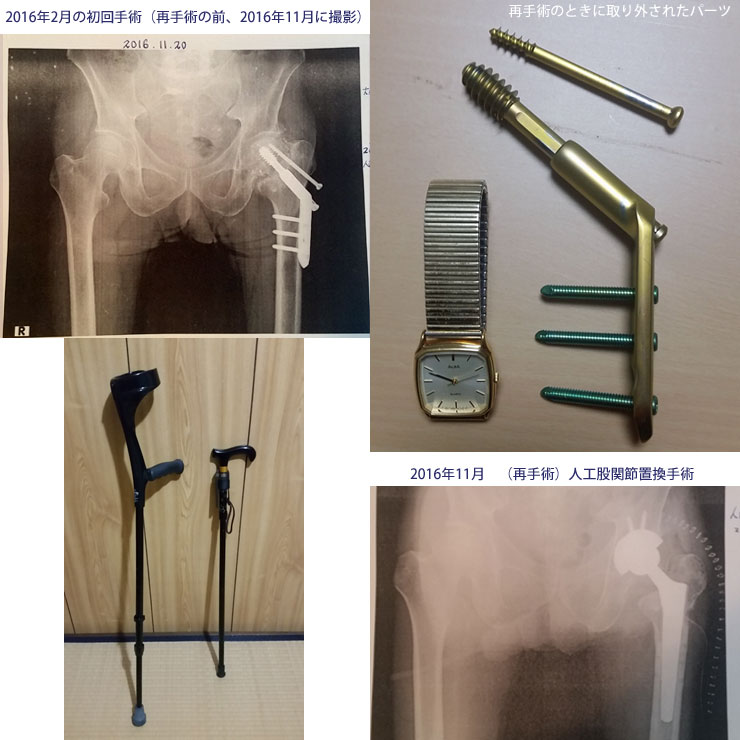 大腿骨骨折手術レントゲン写真